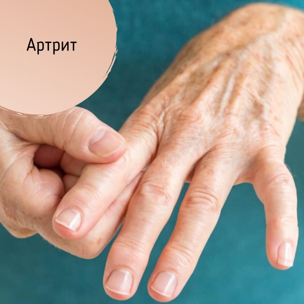 12 октября – всемирный день борьбы с артритом