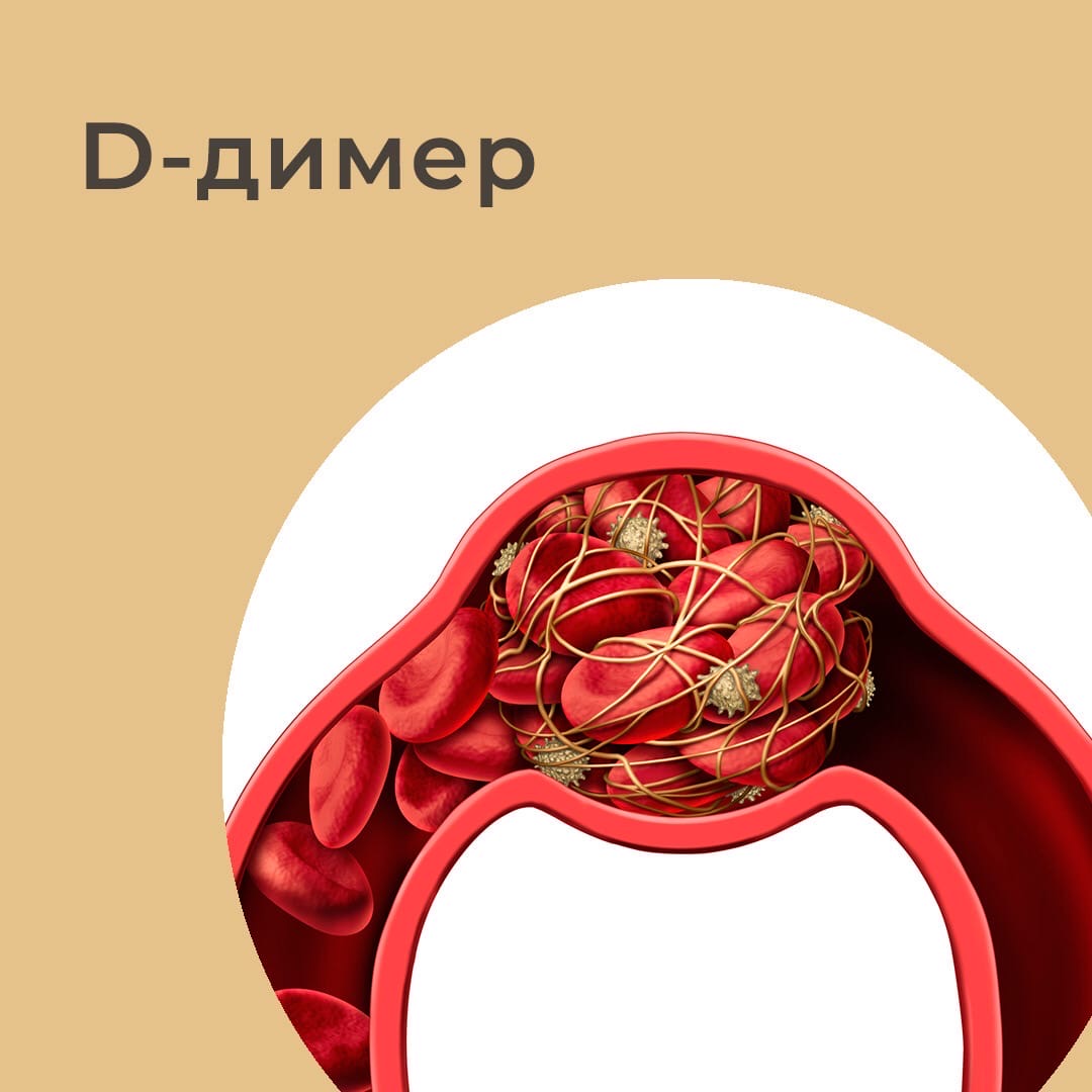 D-димер — эффективный маркер для прогнозирования тромбов!