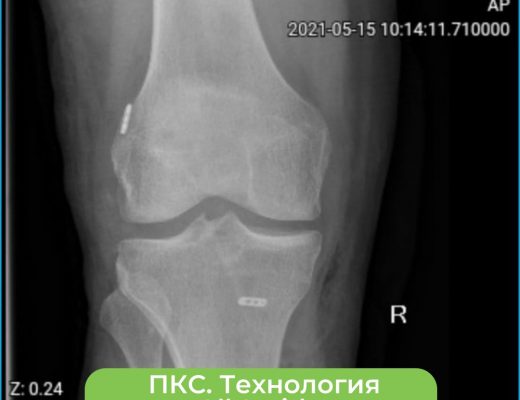 Операция по пластике крестообразной связки. Новые технологии на страже вашего здоровья!